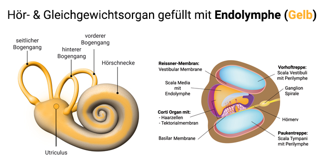 Endolymphatischer Hydrops durch Zunahme von kaliumreiche Endolymphe im Innenohr (Gelb).