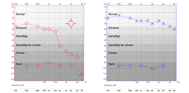 Das Tonaudiogramm zeigt grafisch Hörschwelle und Unbehaglichkeitsschwelle dar (Rot = rechts & Blau = links).